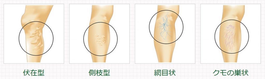 下肢静脈瘤の症状