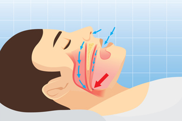 閉塞性睡眠時無呼吸症候群（OSA）